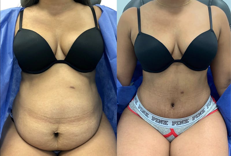 Tummy Tuck Before & After Gallery - Patient 368537 - Image 1
