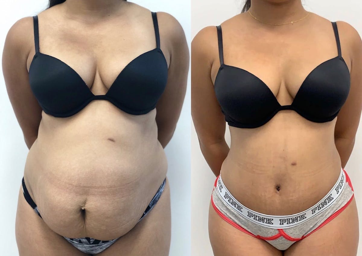 Tummy Tuck Before & After Gallery - Patient 368537 - Image 2