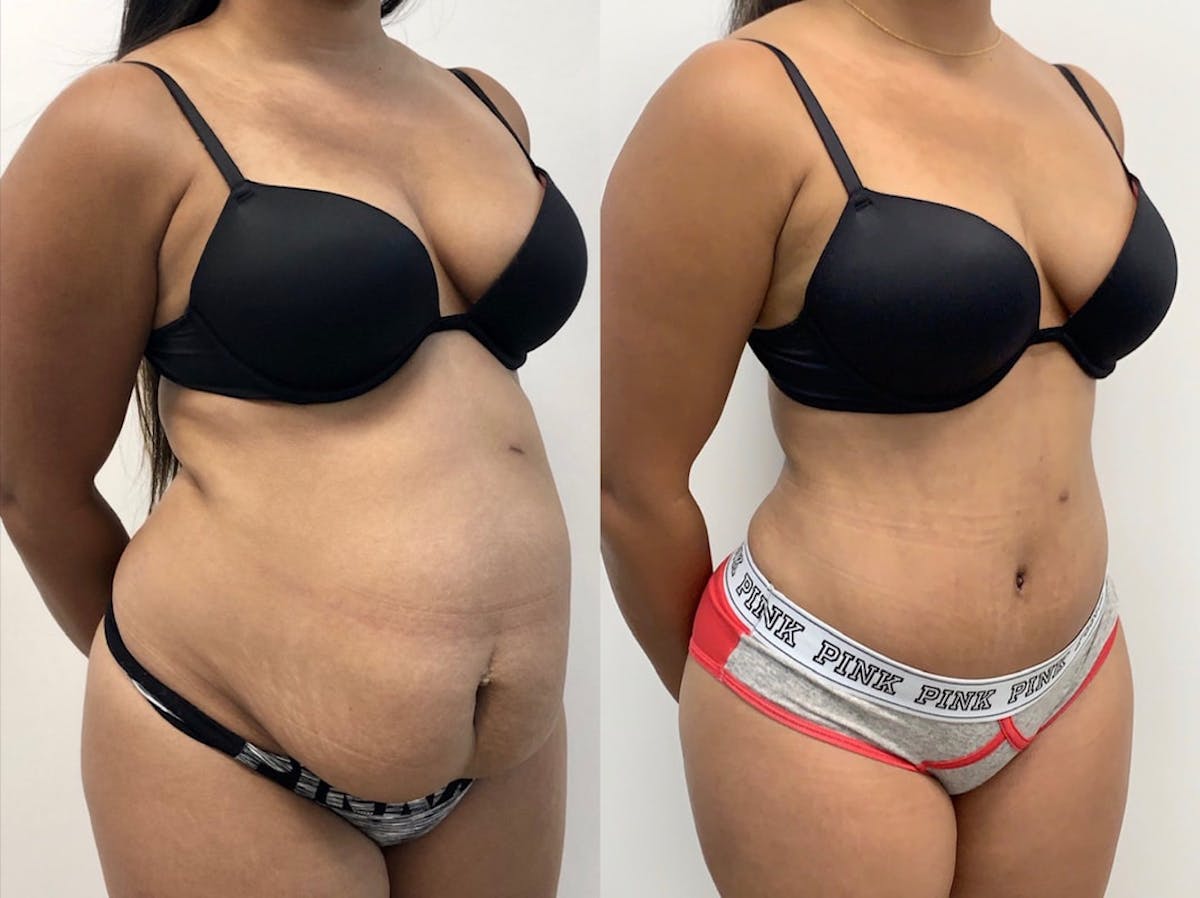 Tummy Tuck Before & After Gallery - Patient 368537 - Image 3