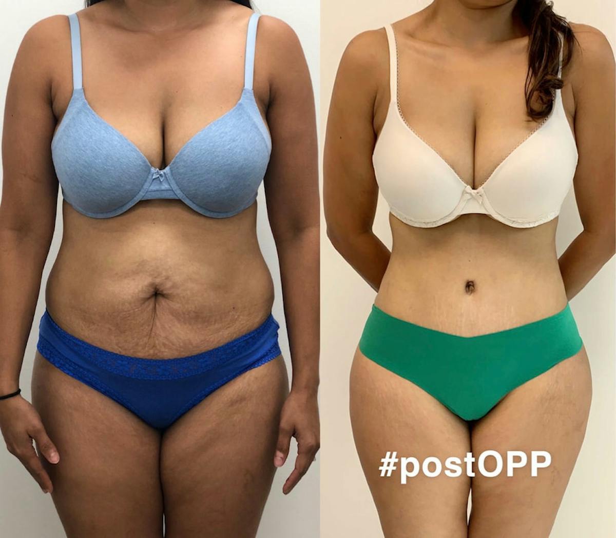 Tummy Tuck Before & After Gallery - Patient 402775 - Image 1