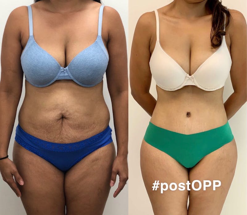 Tummy Tuck Before & After Gallery - Patient 402775 - Image 1