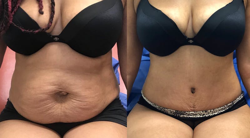 Tummy Tuck Before & After Gallery - Patient 266545 - Image 1