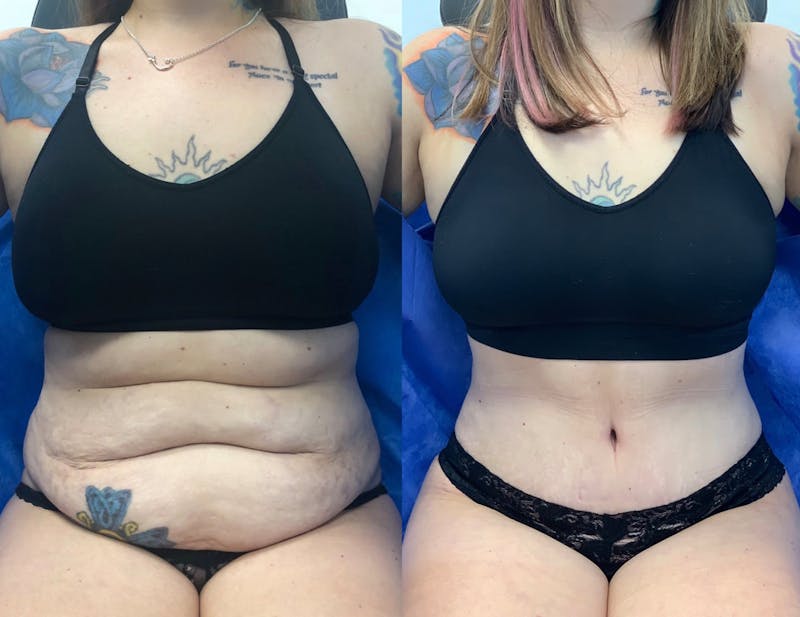 Tummy Tuck Before & After Gallery - Patient 302456 - Image 1
