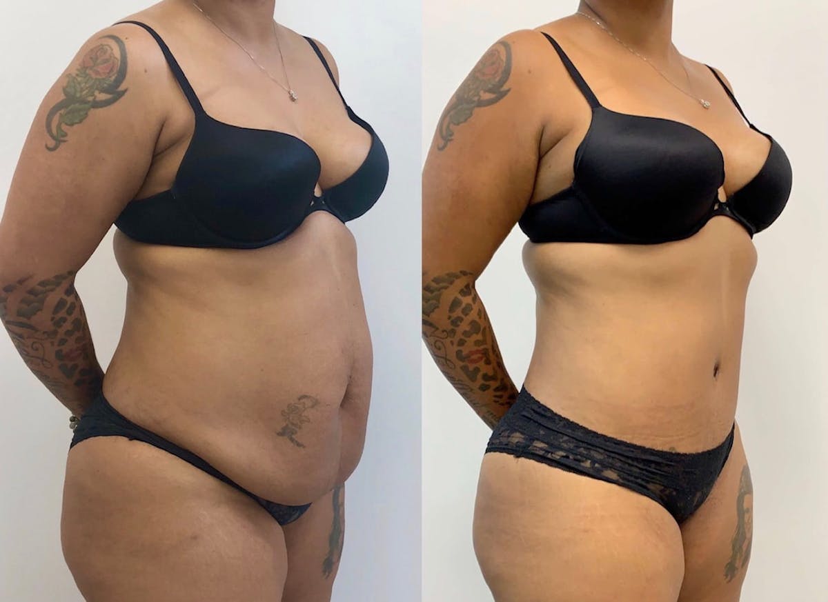 Tummy Tuck Before & After Gallery - Patient 403083 - Image 2
