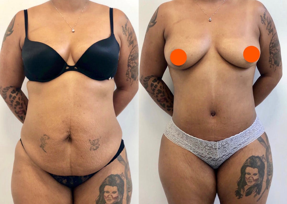 Tummy Tuck Before & After Gallery - Patient 403083 - Image 1