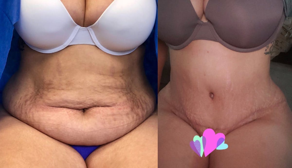 Tummy Tuck Before & After Gallery - Patient 363700 - Image 1