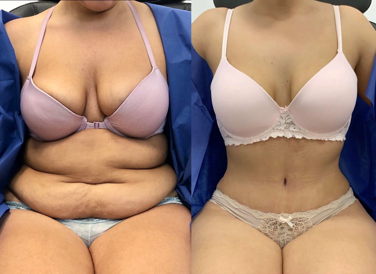 Tummy Tuck Before & After Gallery - Patient 371176 - Image 1