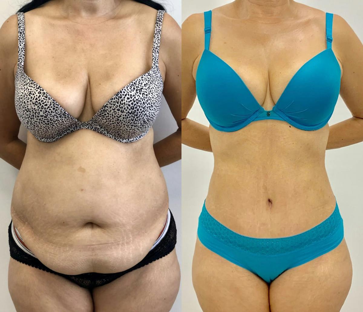 Tummy Tuck Before & After Gallery - Patient 108314 - Image 1