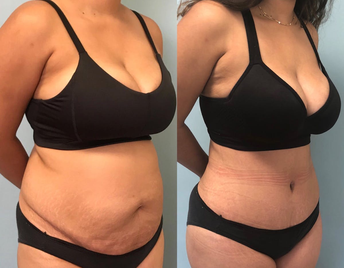 Tummy Tuck Before & After Gallery - Patient 230831 - Image 2
