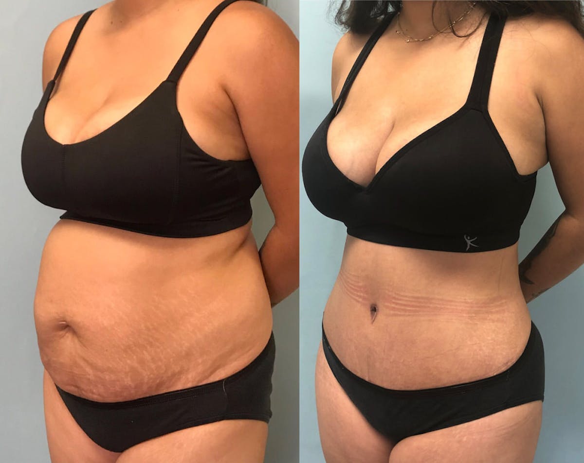 Tummy Tuck Before & After Gallery - Patient 230831 - Image 3