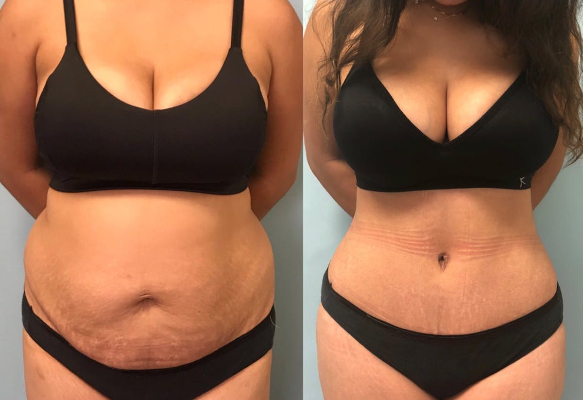 Tummy Tuck Before & After Gallery - Patient 230831 - Image 1