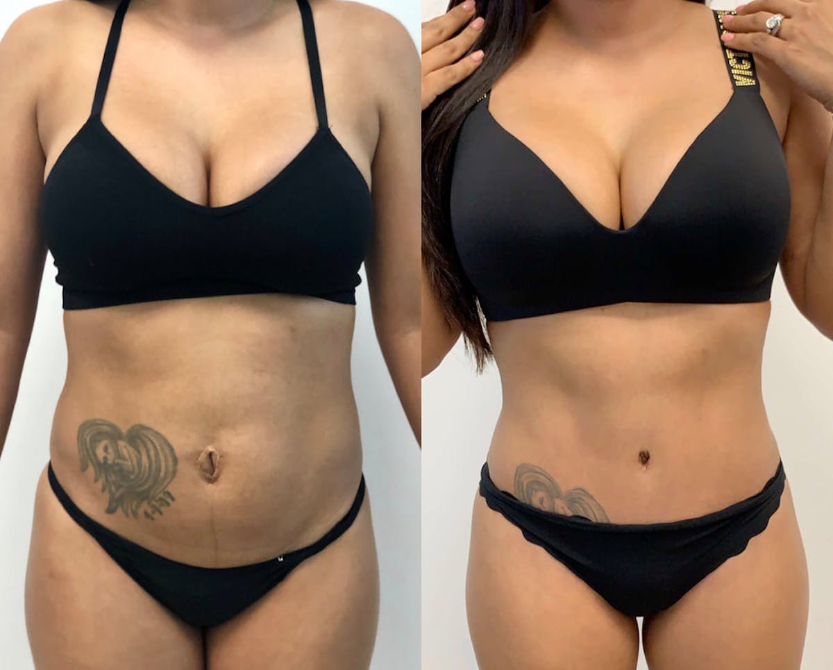 Tummy Tuck Before & After Gallery - Patient 331947 - Image 1