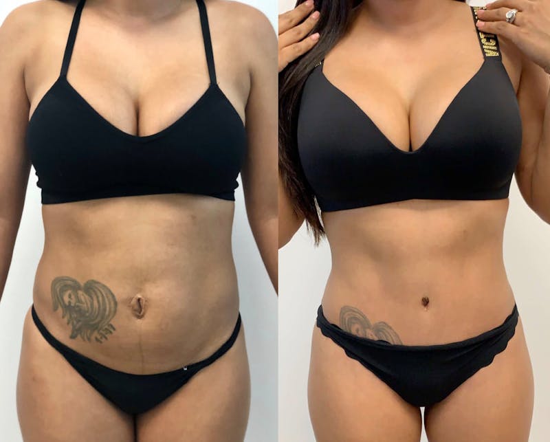 Tummy Tuck Before & After Gallery - Patient 331947 - Image 1