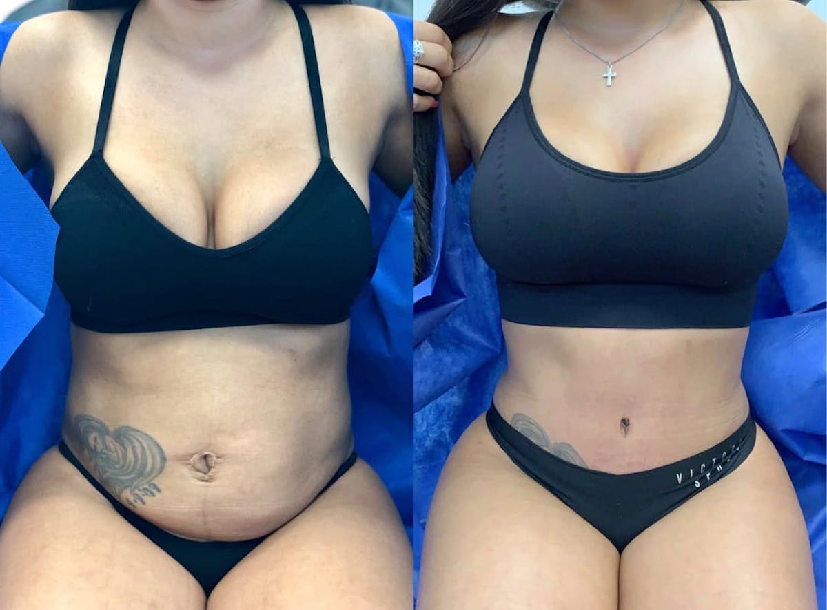 Tummy Tuck Before & After Gallery - Patient 331947 - Image 2