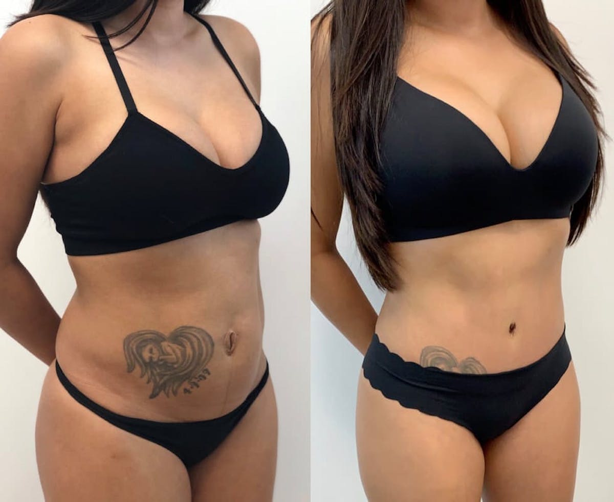 Tummy Tuck Before & After Gallery - Patient 331947 - Image 3