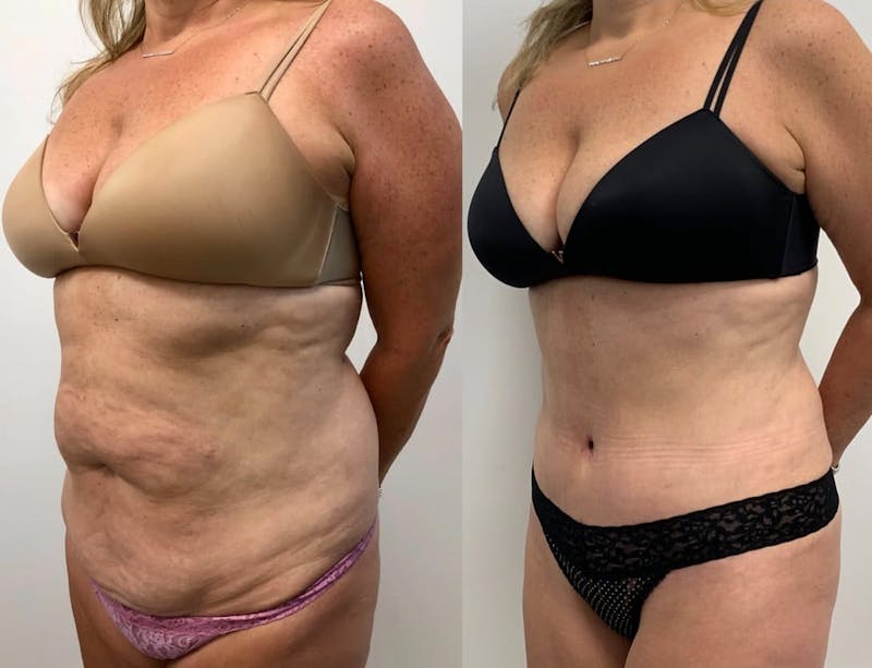 Tummy Tuck Before & After Gallery - Patient 236566 - Image 1