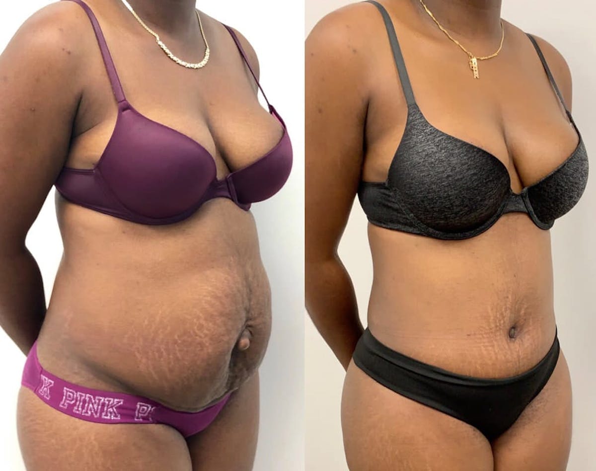Tummy Tuck Before & After Gallery - Patient 343560 - Image 2