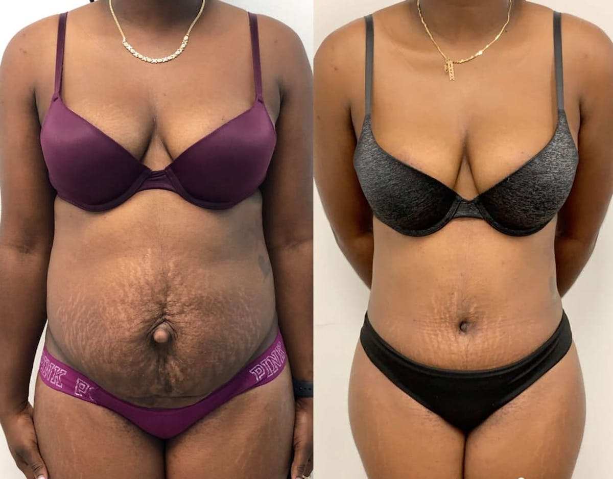 Tummy Tuck Before & After Gallery - Patient 343560 - Image 1