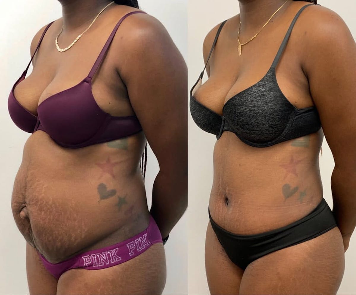 Tummy Tuck Before & After Gallery - Patient 343560 - Image 3