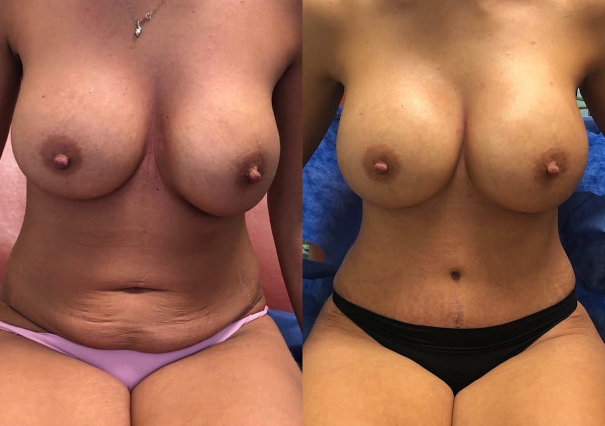 Tummy Tuck Before & After Gallery - Patient 242036 - Image 1