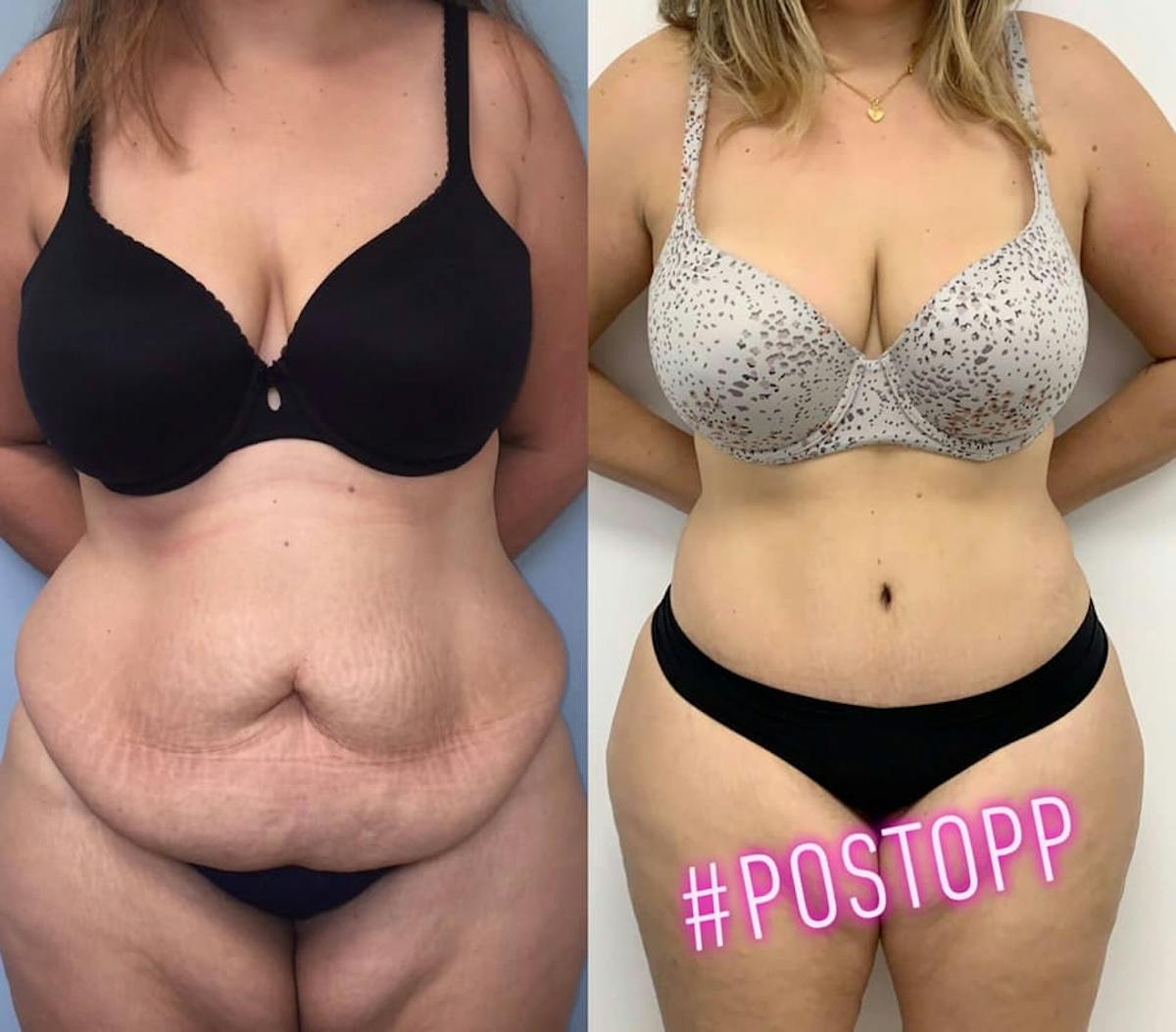 Tummy Tuck Before & After Gallery - Patient 115921 - Image 1