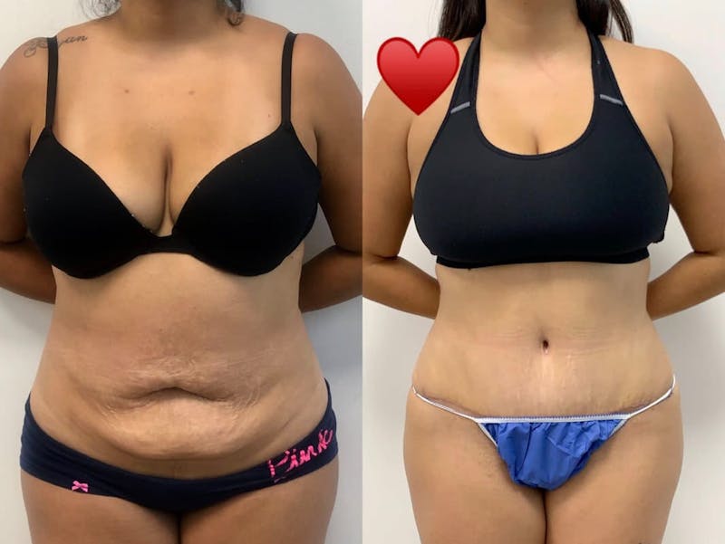 Tummy Tuck Before & After Gallery - Patient 340427 - Image 1