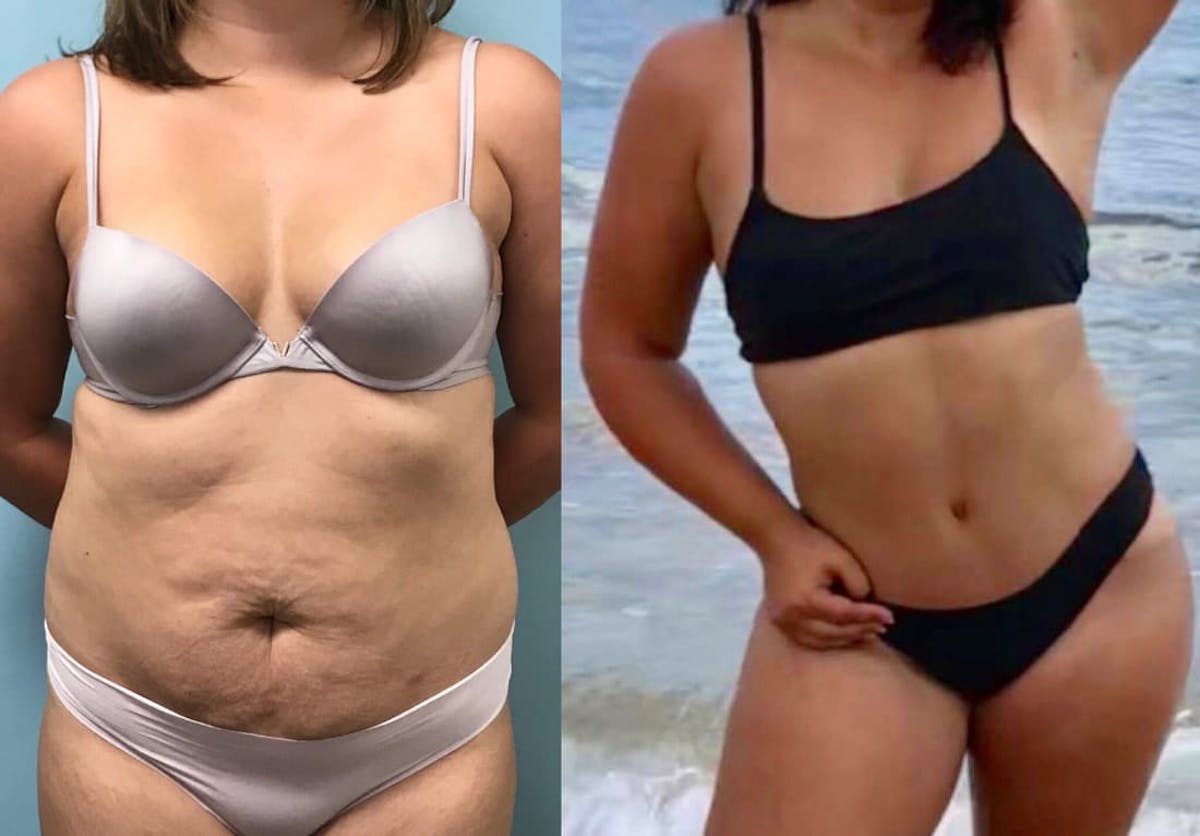 Tummy Tuck Before & After Gallery - Patient 161576 - Image 1