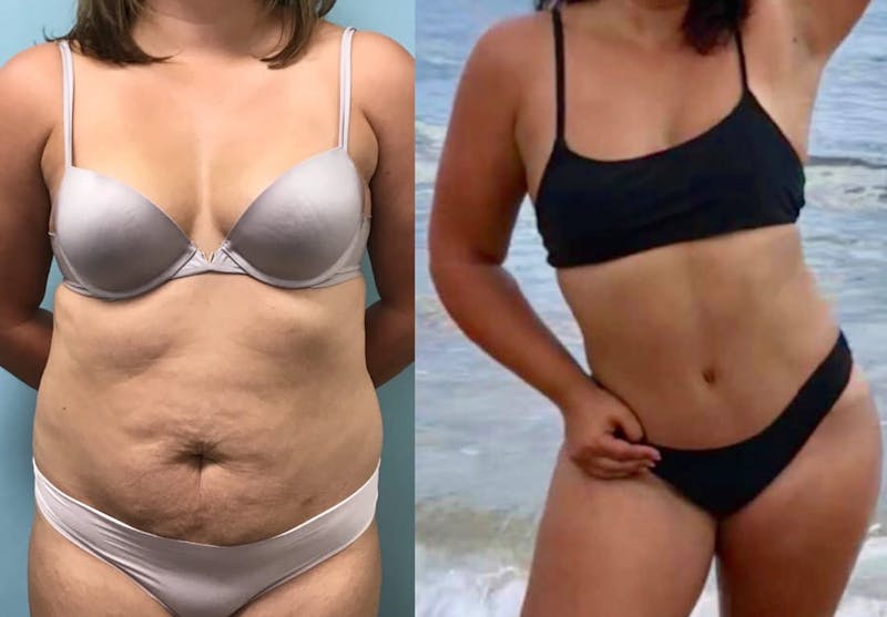 Tummy Tuck Before & After Gallery - Patient 161576 - Image 1