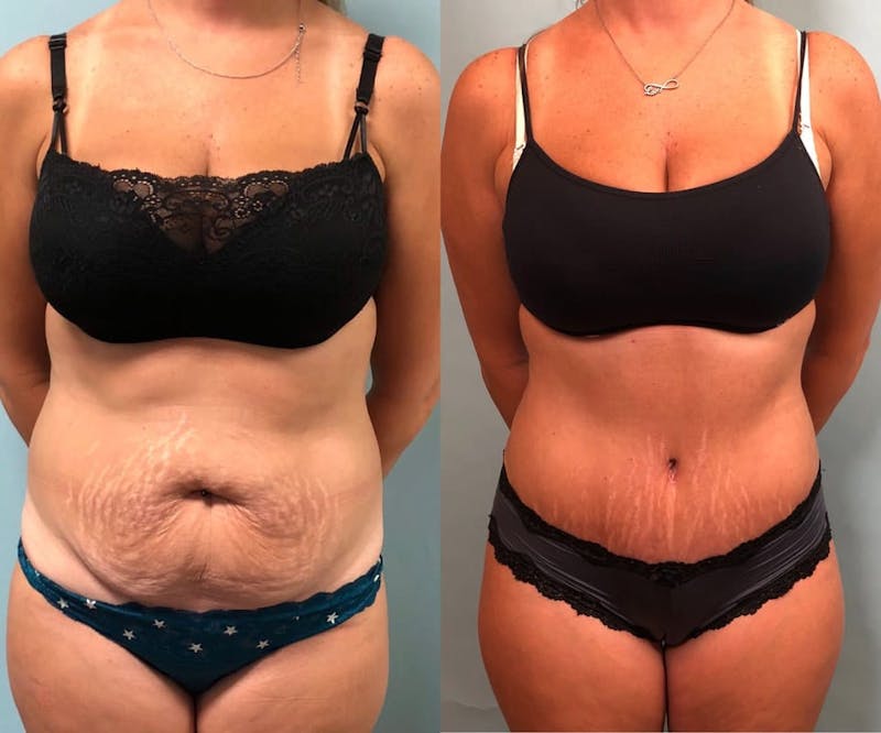 Tummy Tuck Before & After Gallery - Patient 420466 - Image 1