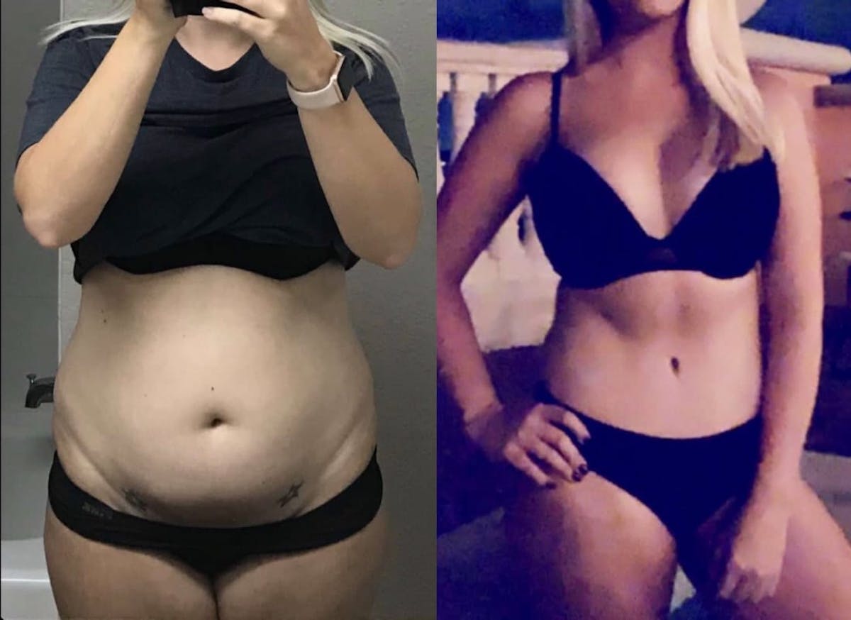 Tummy Tuck Before & After Gallery - Patient 357832 - Image 1