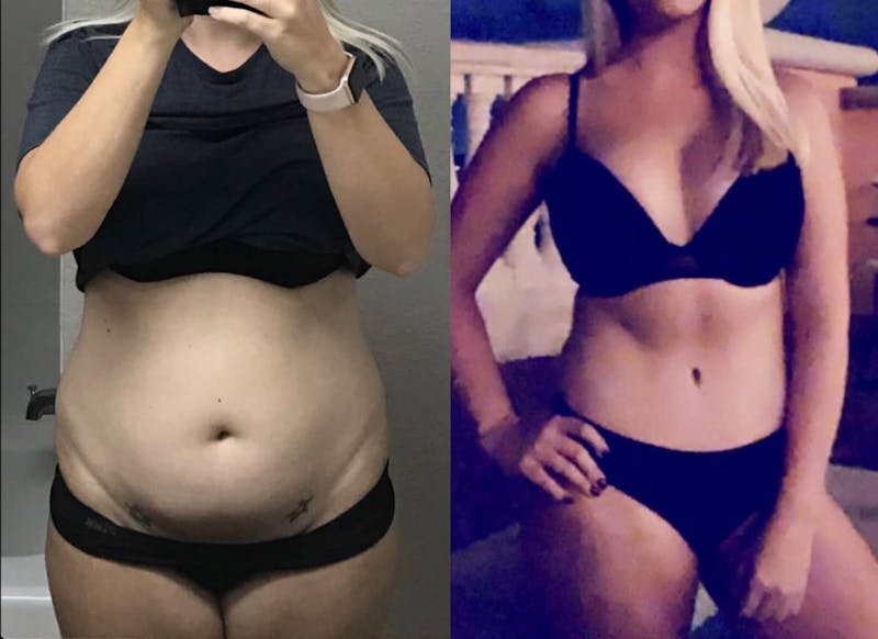 Tummy Tuck Before & After Gallery - Patient 357832 - Image 1