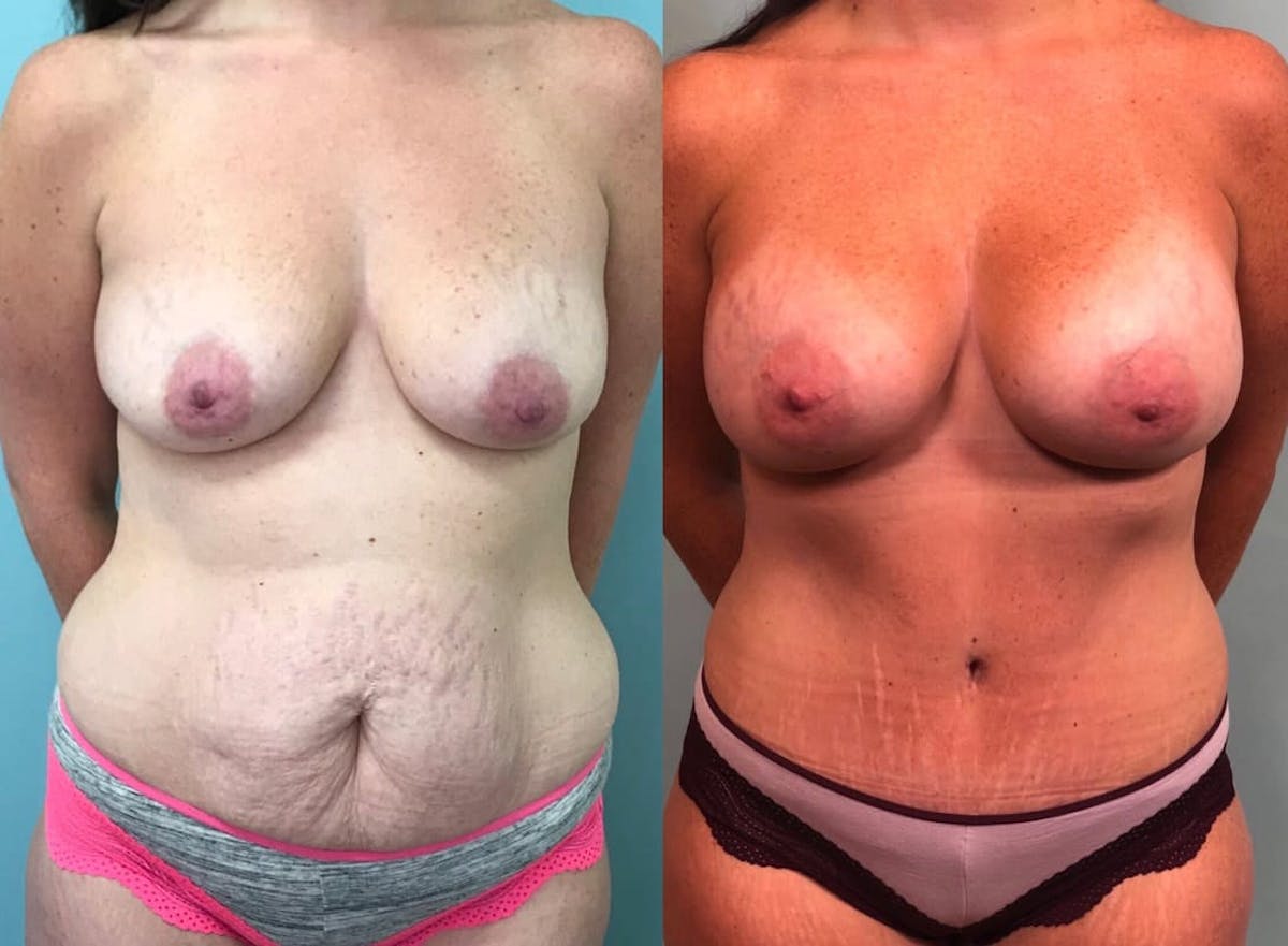 Tummy Tuck Before & After Gallery - Patient 244387 - Image 1