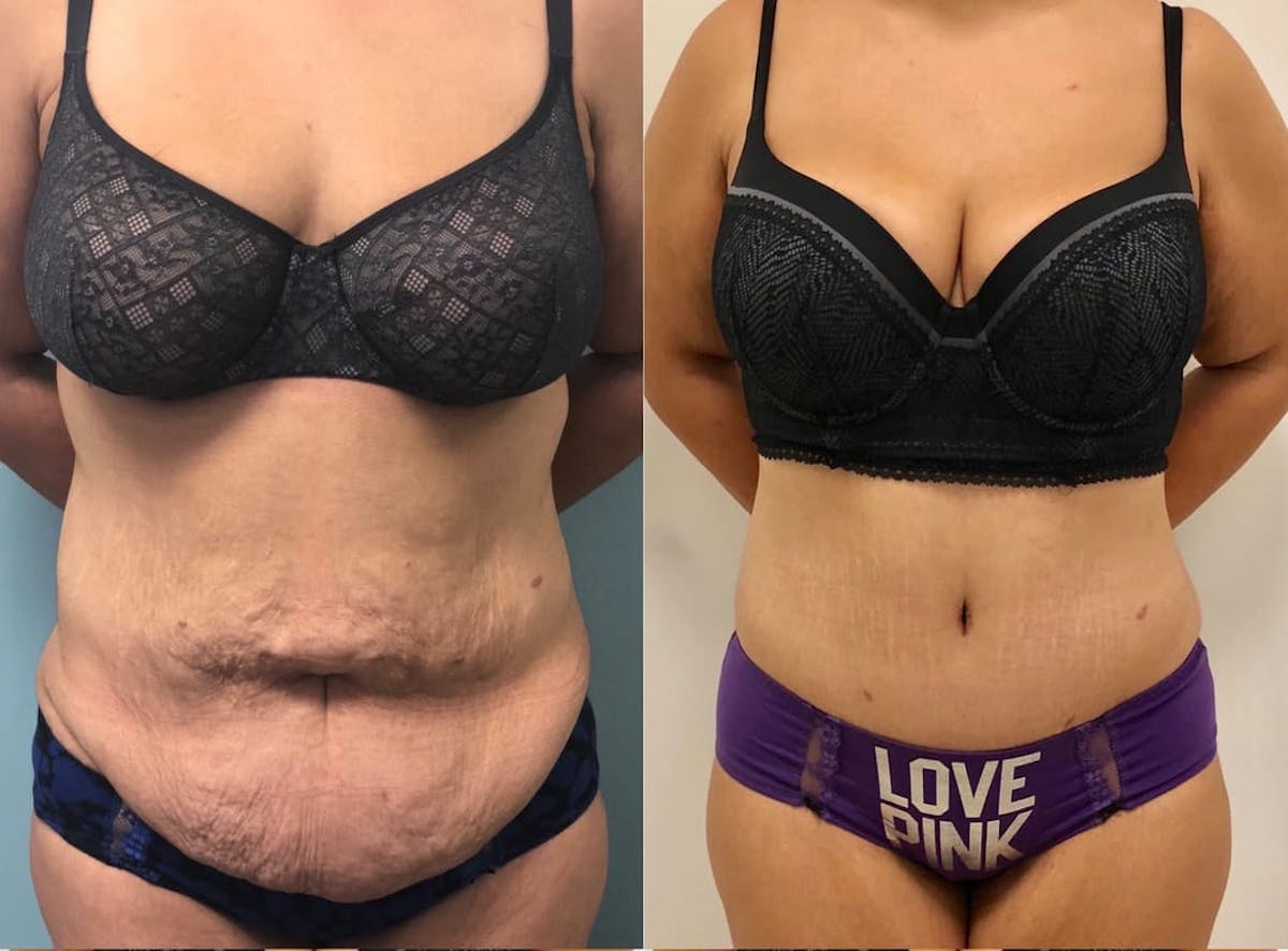 Tummy Tuck Before & After Gallery - Patient 802107 - Image 1