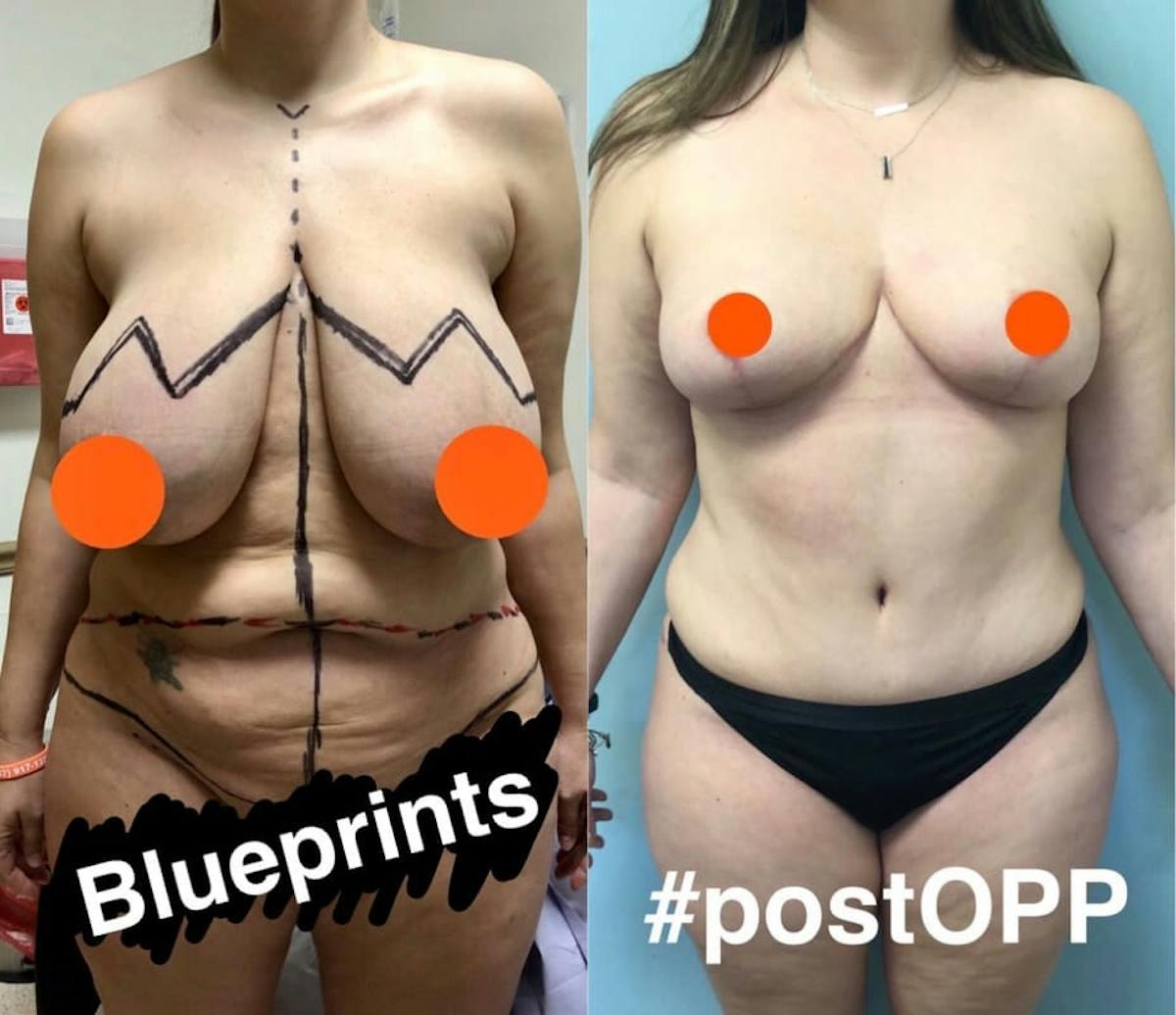Tummy Tuck Before & After Gallery - Patient 360162 - Image 1
