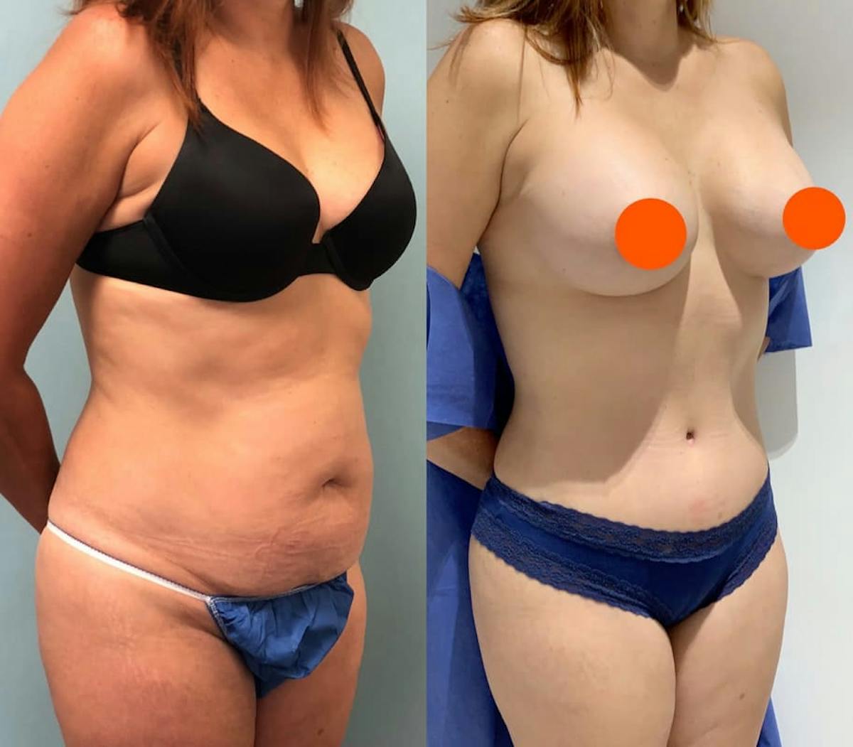 Tummy Tuck Before & After Gallery - Patient 319645 - Image 2