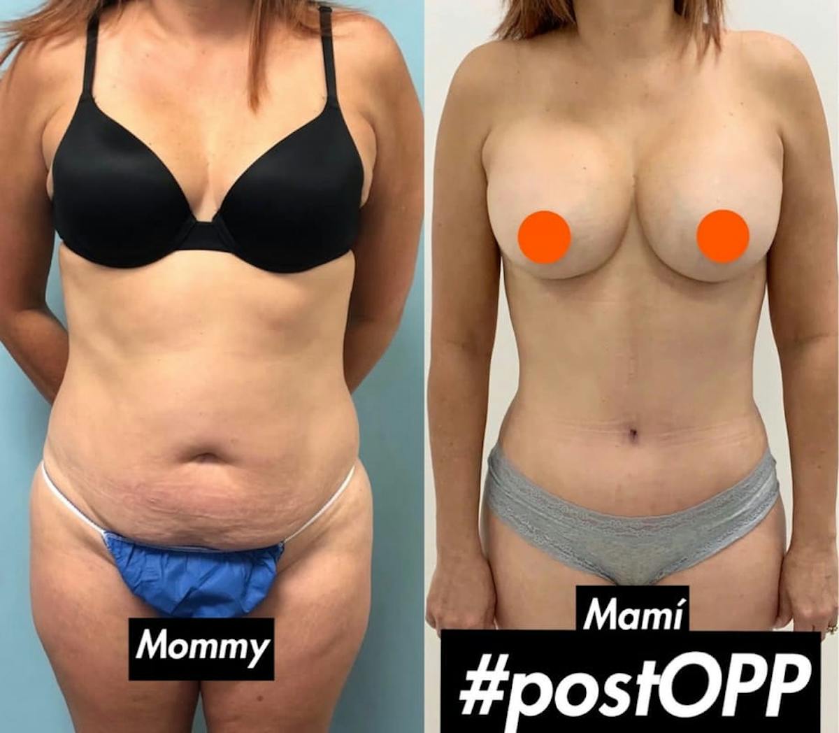 Tummy Tuck Before & After Gallery - Patient 319645 - Image 1