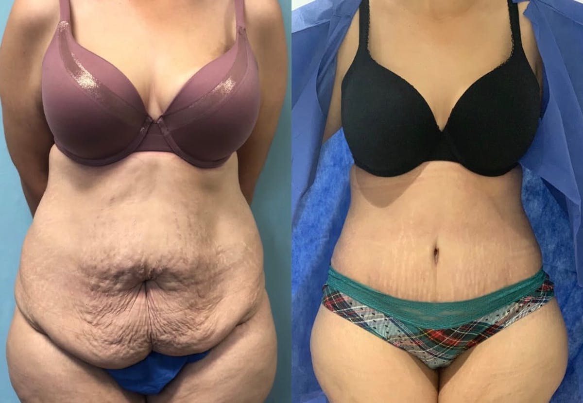 Tummy Tuck Before & After Gallery - Patient 703238 - Image 1