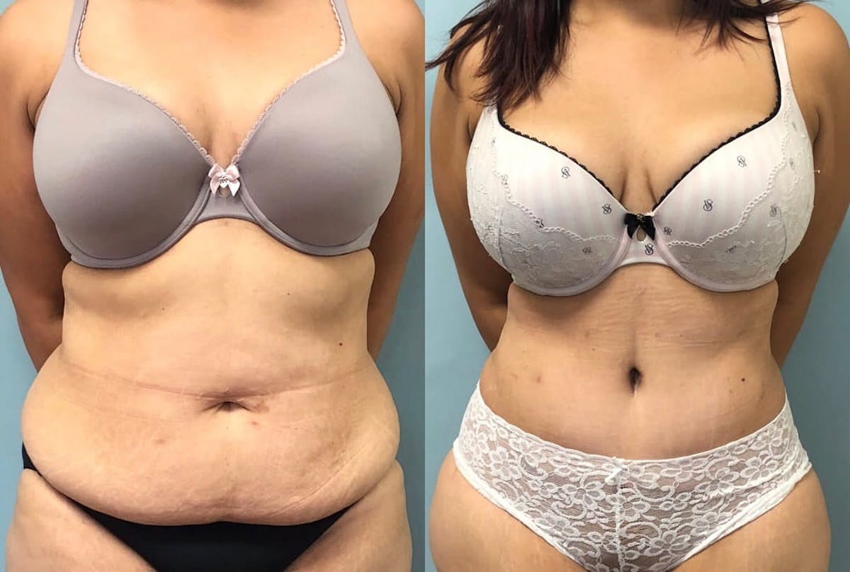 Tummy Tuck Before & After Gallery - Patient 293456 - Image 1