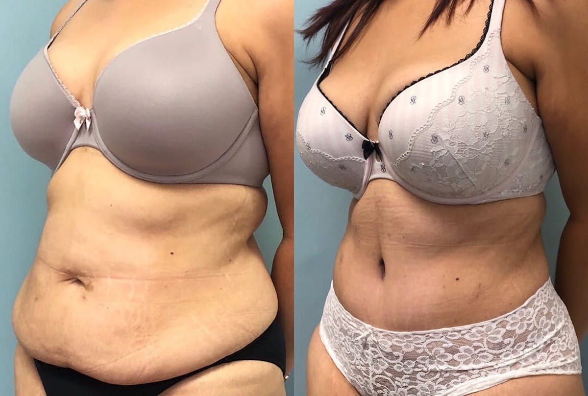 Tummy Tuck Before & After Gallery - Patient 293456 - Image 2
