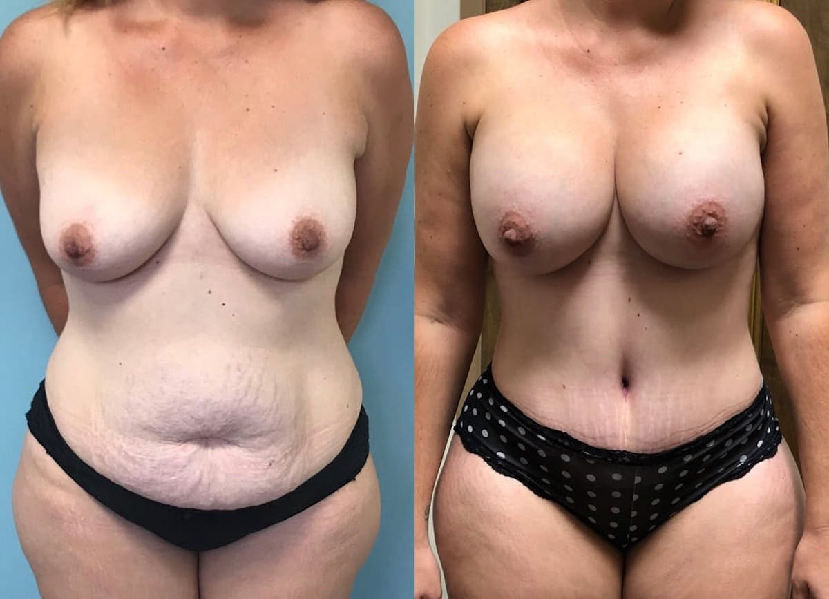 Tummy Tuck Before & After Gallery - Patient 298861 - Image 1
