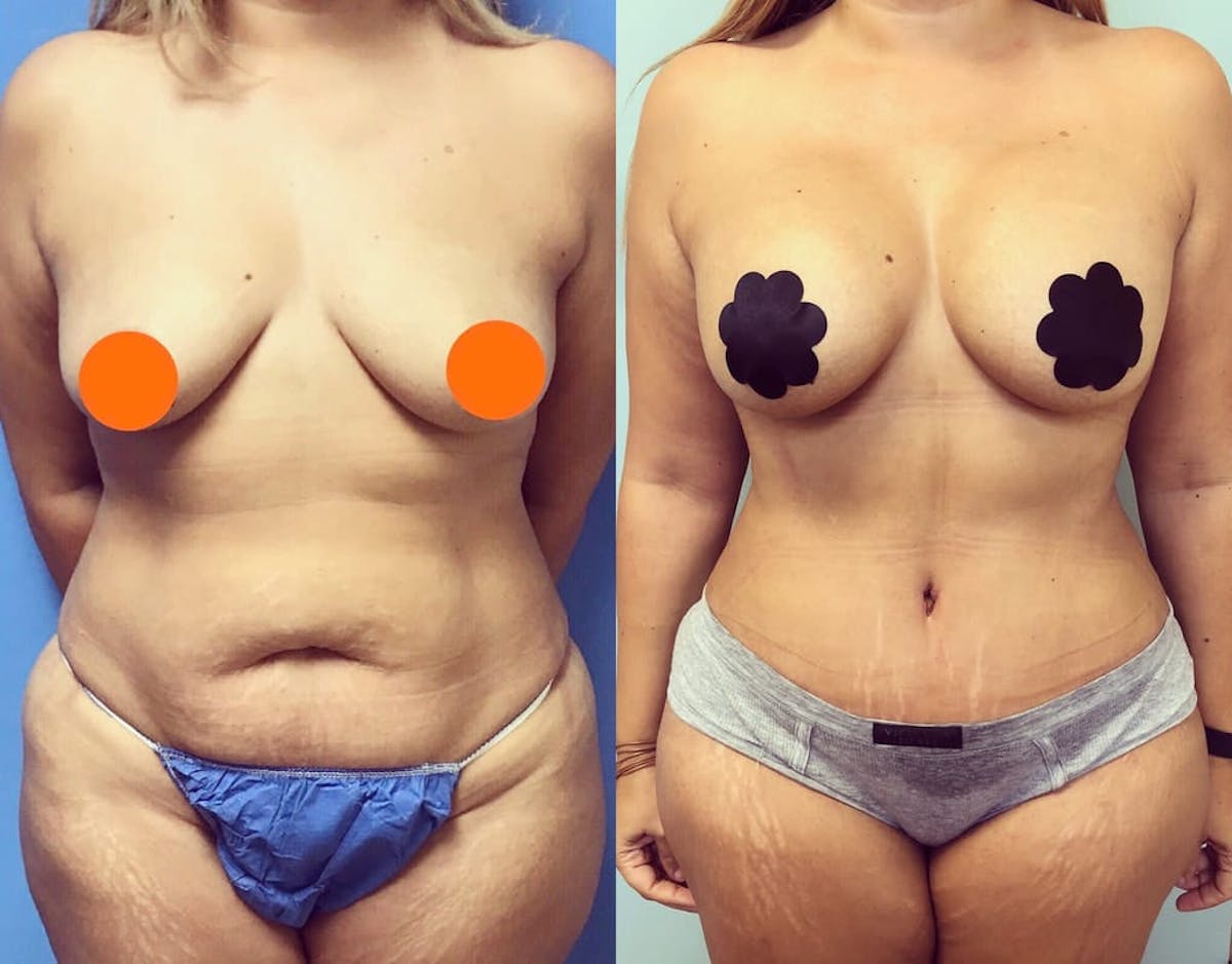 Tummy Tuck Before & After Gallery - Patient 278870 - Image 1