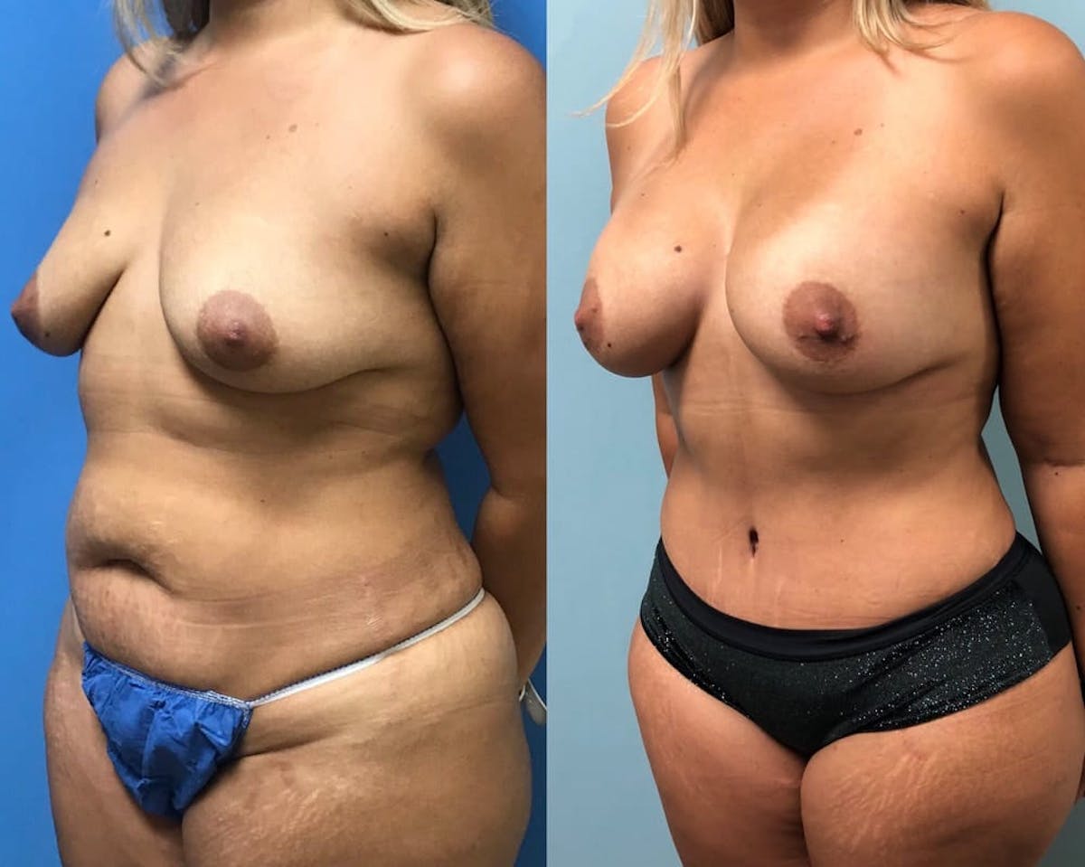 Tummy Tuck Before & After Gallery - Patient 278870 - Image 2