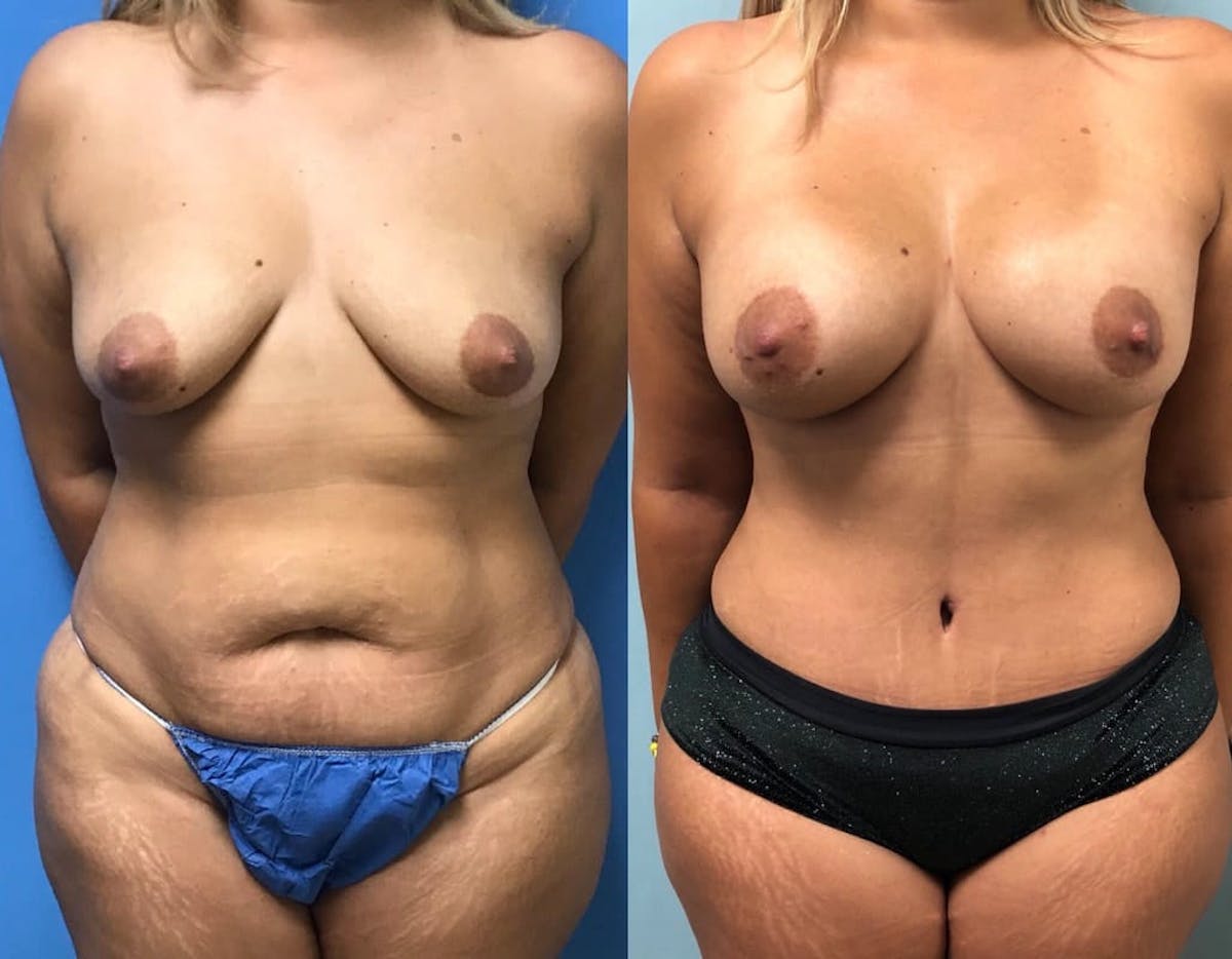 Tummy Tuck Before & After Gallery - Patient 278870 - Image 3