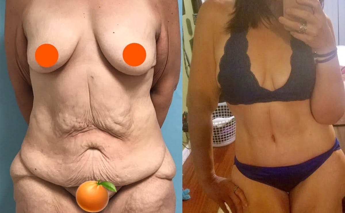 Tummy Tuck Before & After Gallery - Patient 191504 - Image 1