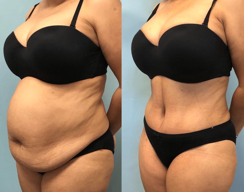 Tummy Tuck Before & After Gallery - Patient 416145 - Image 1