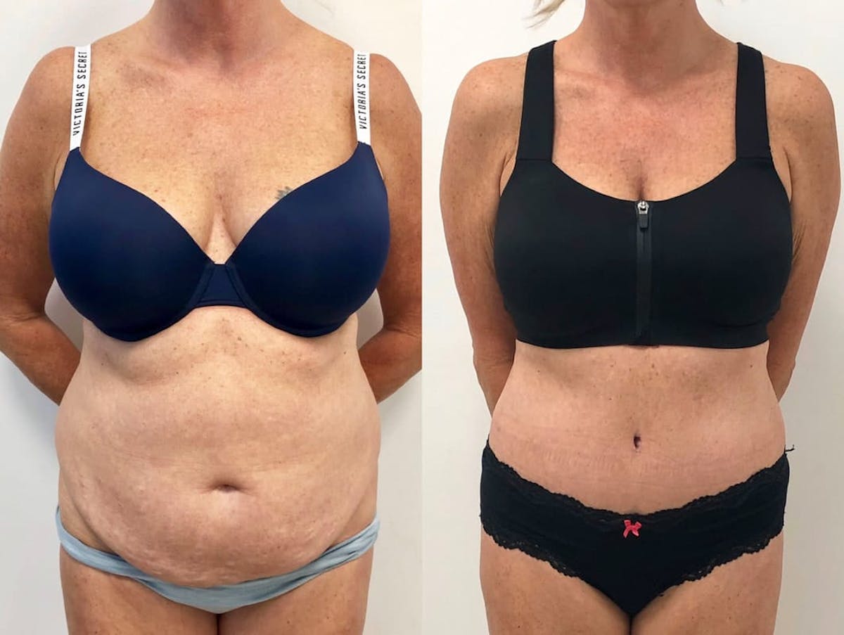 Tummy Tuck Before & After Gallery - Patient 425725 - Image 1