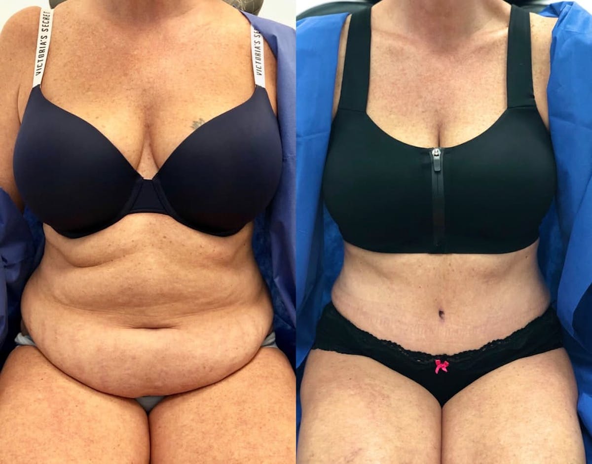Tummy Tuck Before & After Gallery - Patient 425725 - Image 2