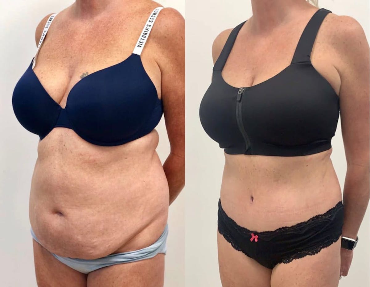 Tummy Tuck Before & After Gallery - Patient 425725 - Image 3
