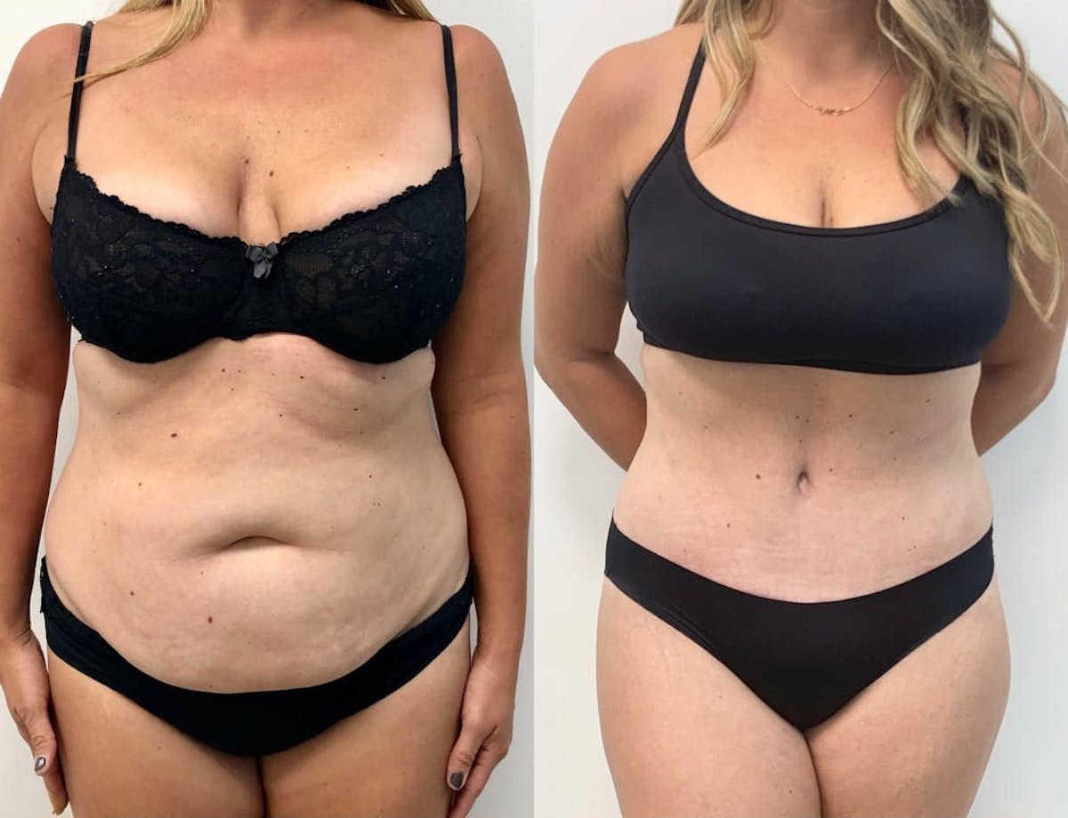 Tummy Tuck Before & After Gallery - Patient 735033 - Image 1