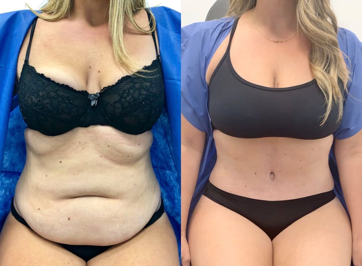 Tummy Tuck Before & After Gallery - Patient 735033 - Image 2